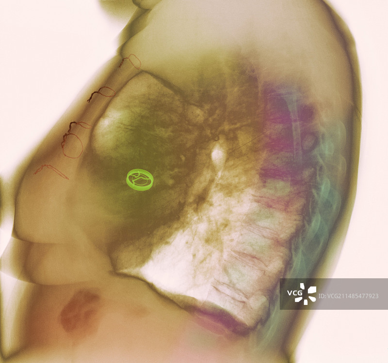心脏瓣膜置换X光片图片素材
