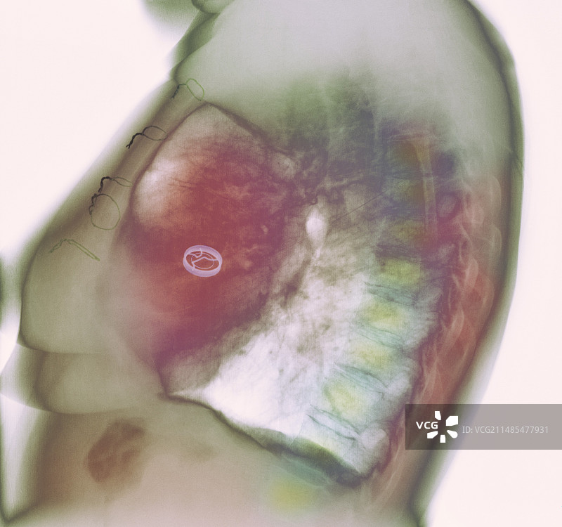 心脏瓣膜置换X光片图片素材