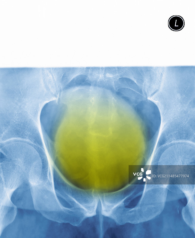 肾结石X光片图片素材