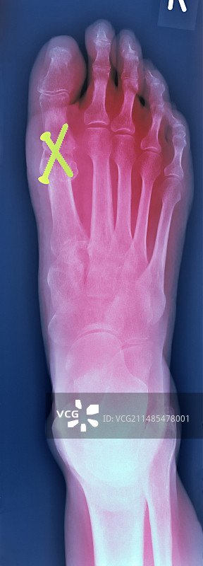 脚部X光图图片素材