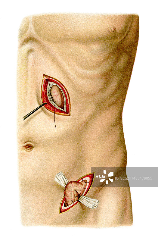 胃和结肠外科手术艺术图片素材