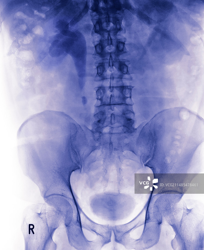 肾结石X光片图片素材