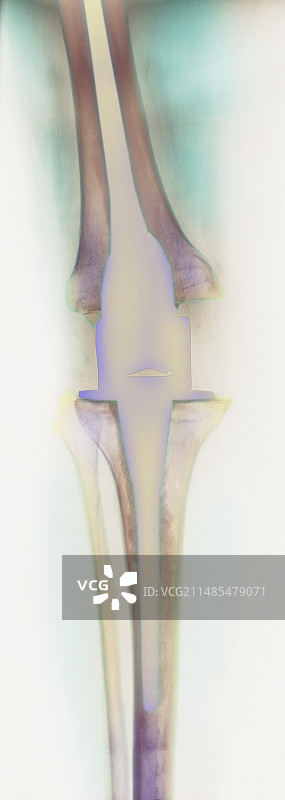 膝关节置换X光片图片素材