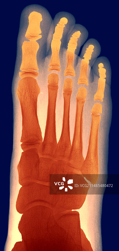 儿童脚部X光片图片素材