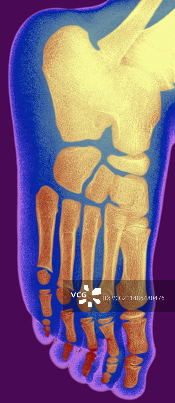 儿童脚部X光片图片素材