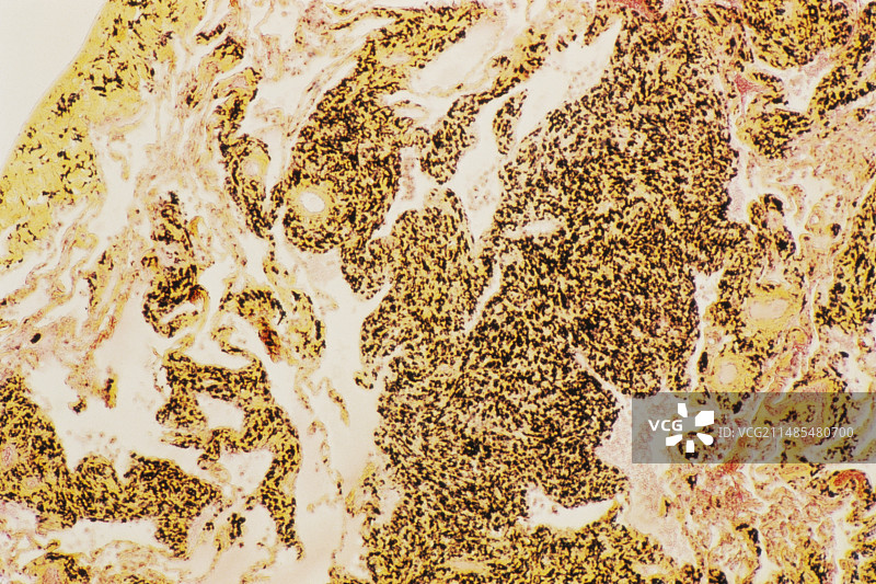 吸入粉尘引起的肺部疾病图片素材