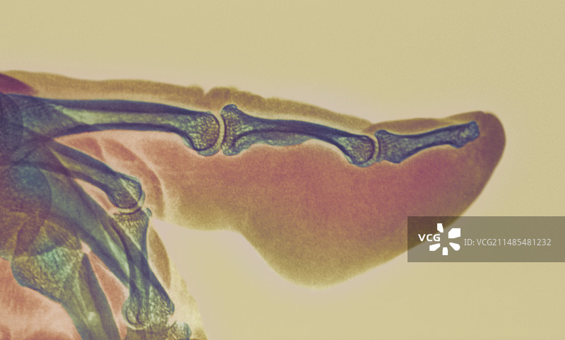 手指发炎X光片图片素材