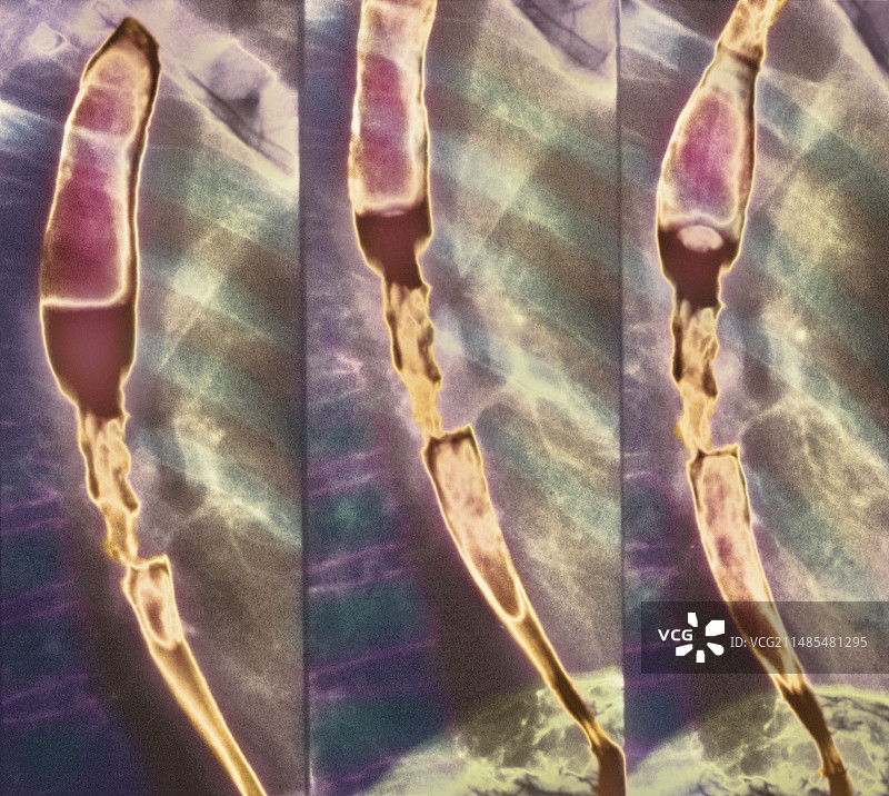 食道狭窄X光片图片素材