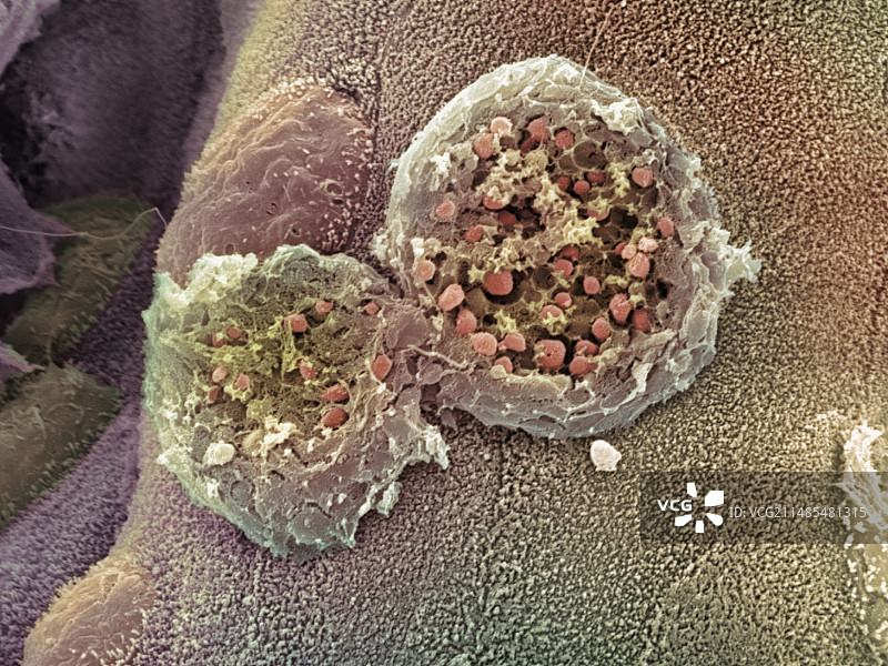溃疡性结肠炎扫描电镜图图片素材
