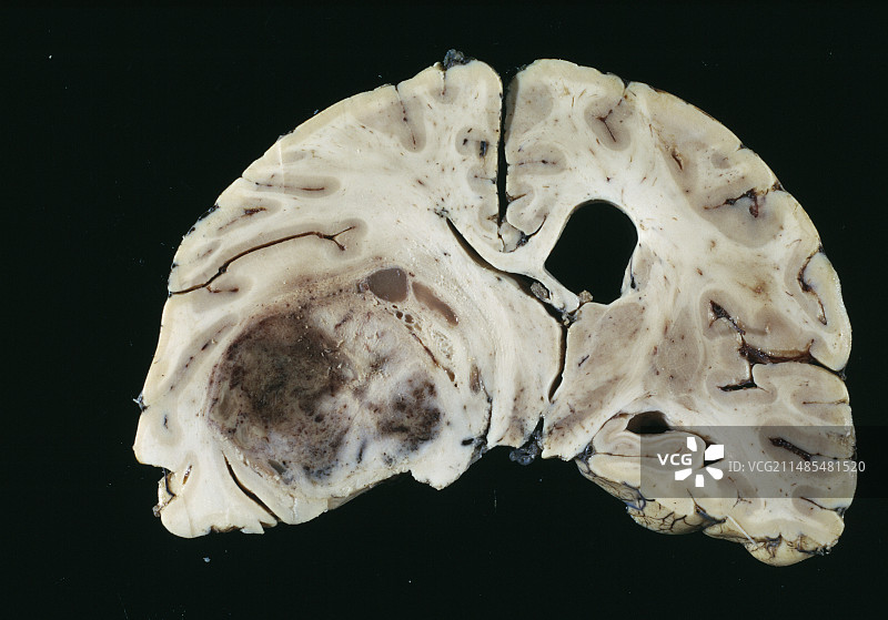 脑肿瘤图片素材