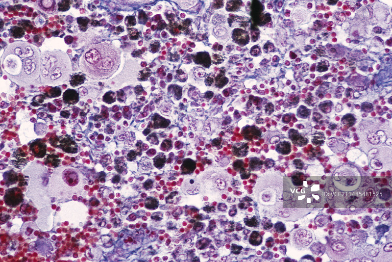 脑肿瘤图片素材