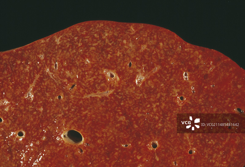 霍奇金病图片素材