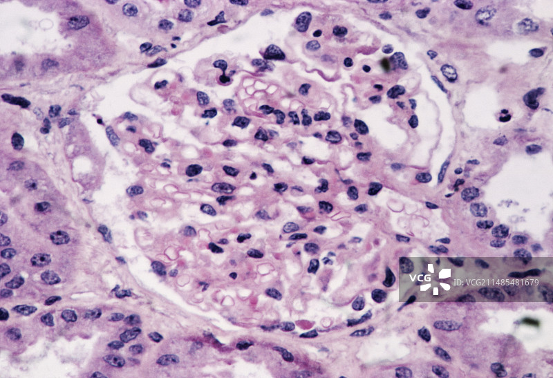 肾脏炎症图片素材