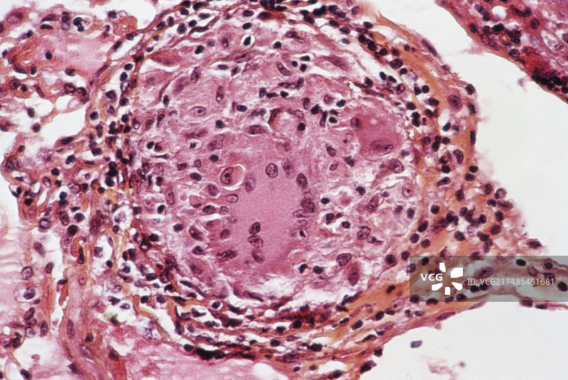 肝脏结节病图片素材