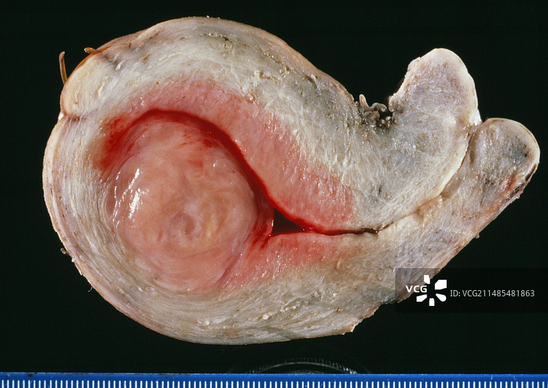 子宫肿瘤图片素材