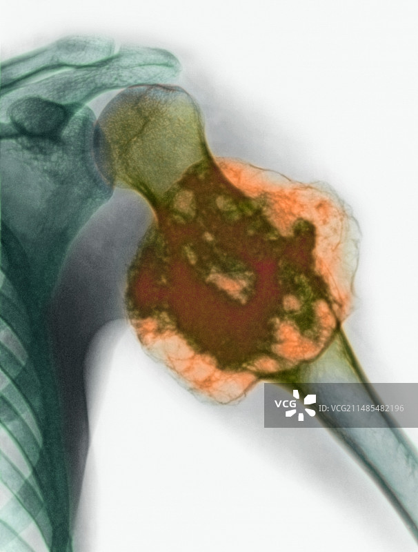 上臂肿瘤X光片图片素材