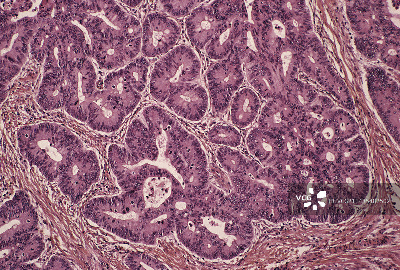 癌性直肠息肉图片素材