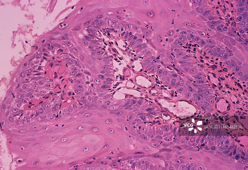 消化性溃疡图片素材