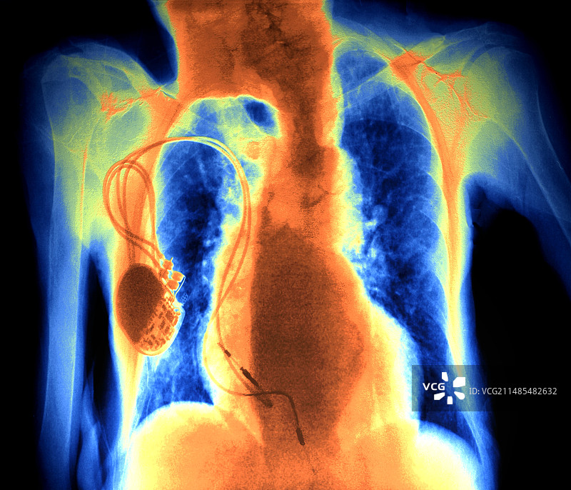 心脏起搏器胸部X光片图片素材