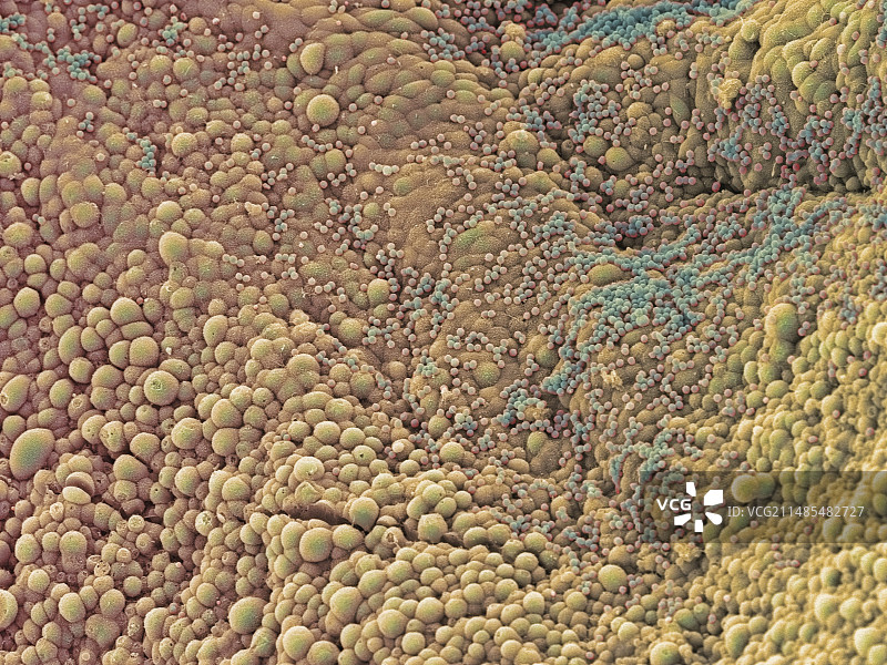 卵巢囊肿扫描电镜图图片素材