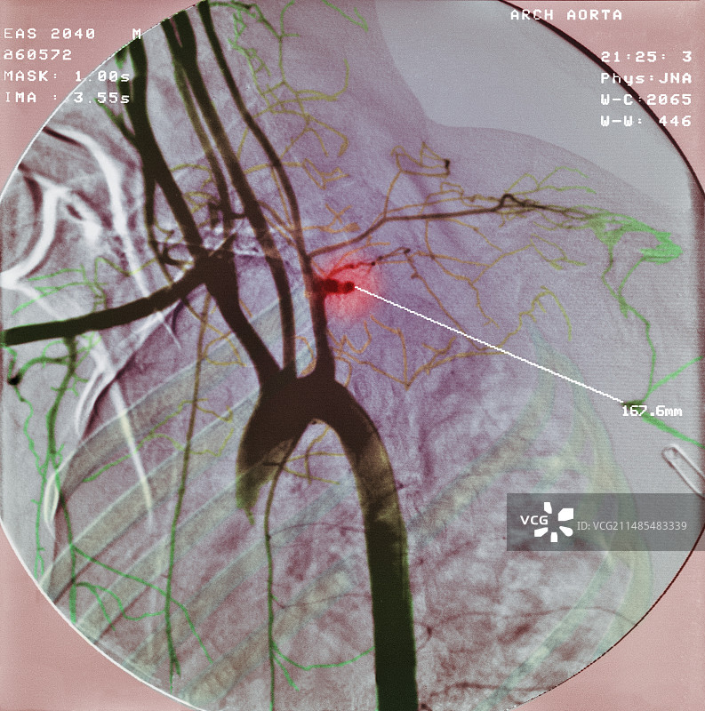 动脉阻塞X光片图片素材