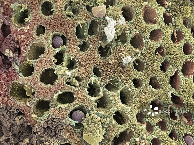 结肠癌，扫描电子显微镜图片素材