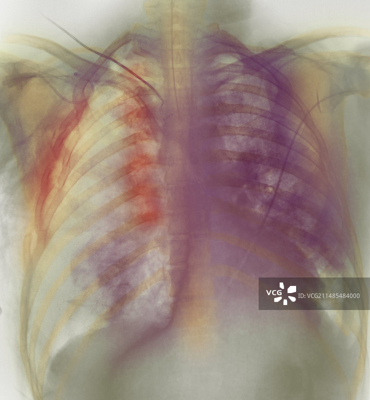 肋骨骨折X光片图片素材