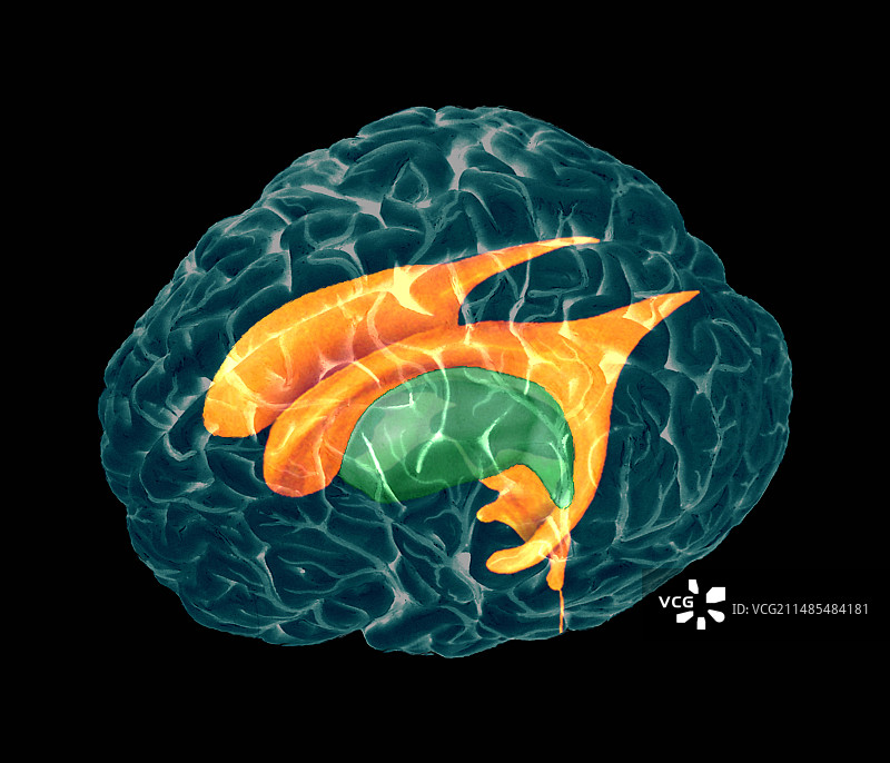 脑室核磁共振成像图片素材