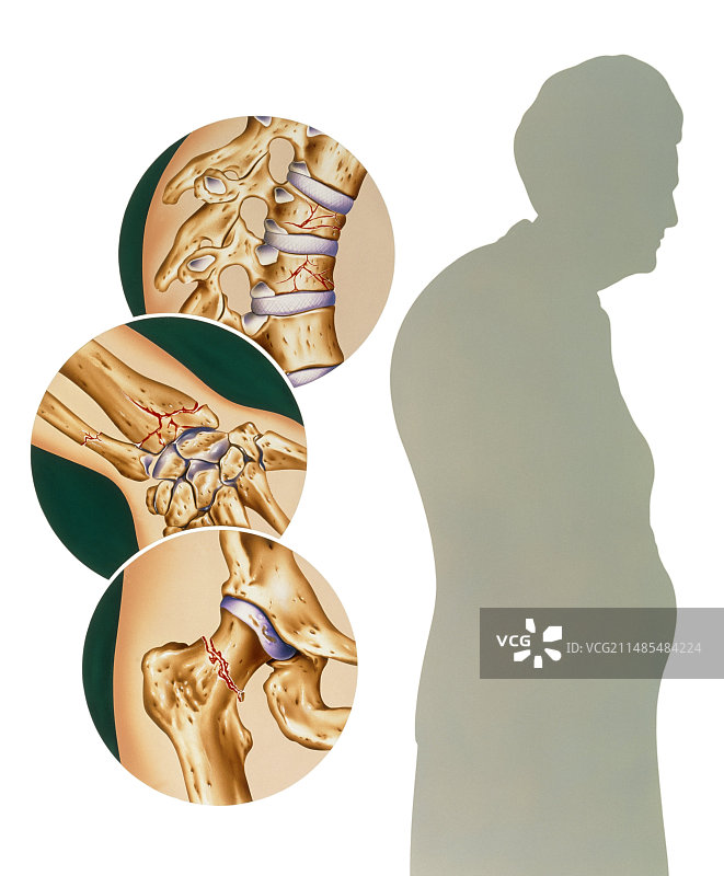 骨质疏松症图片素材