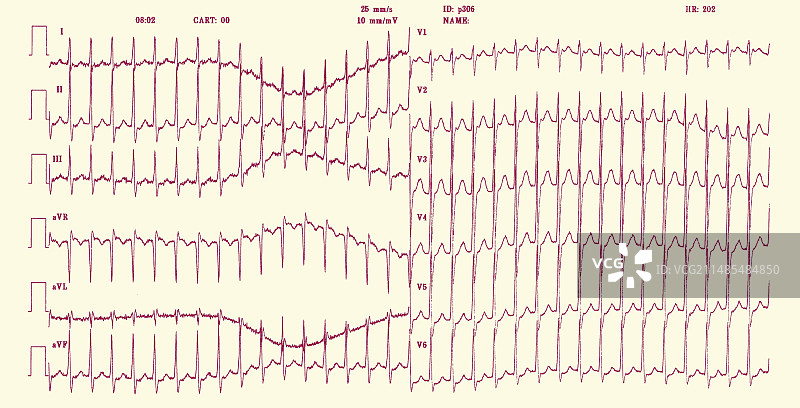 心脏疾病心电图图片素材