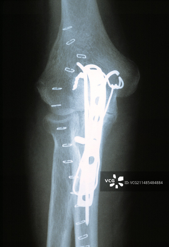 肘部骨折内固定术，X光片图片素材