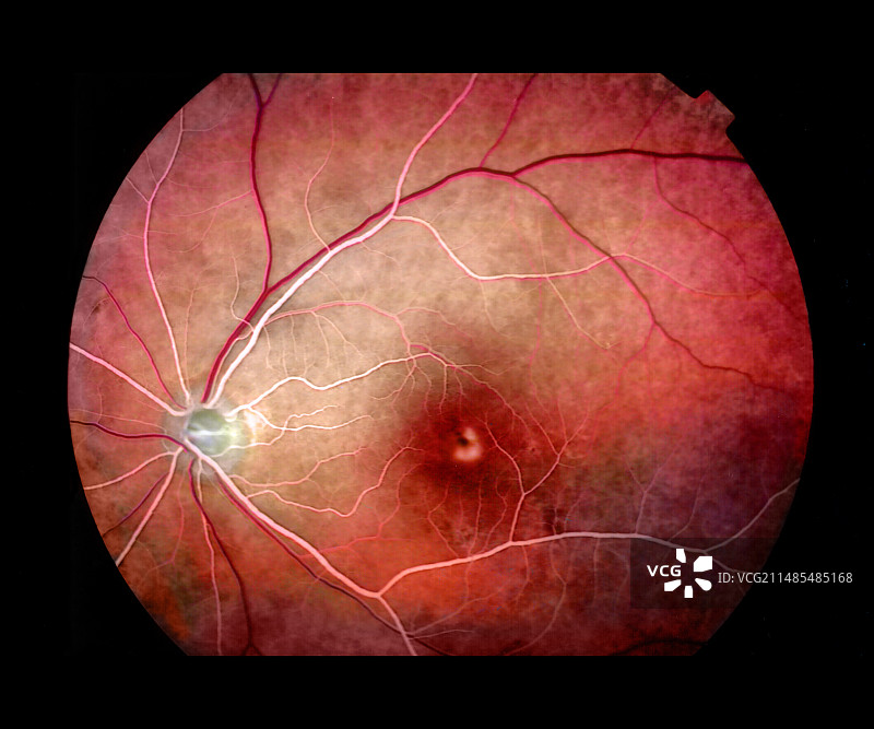 受刺激的黄斑图片素材