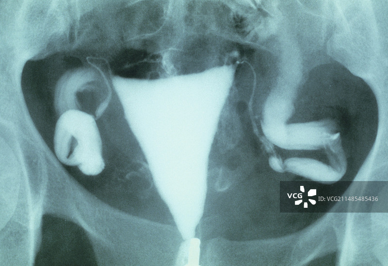 输卵管肿胀X光片图片素材