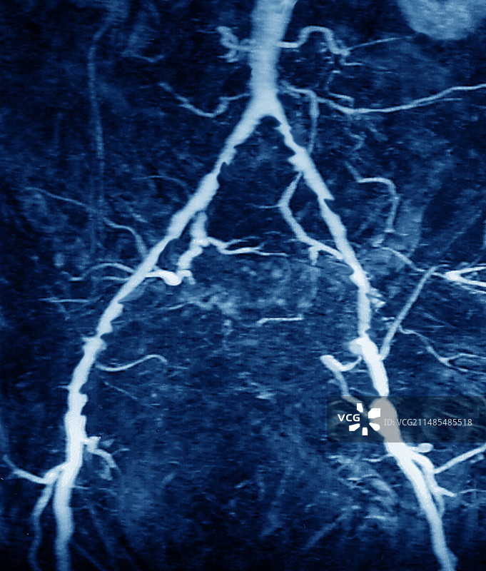 动脉炎，MRA图片素材