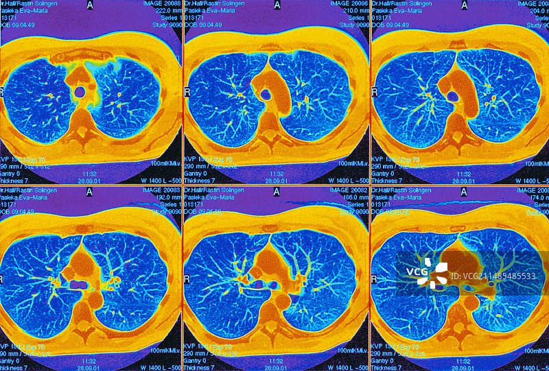 肺部CT扫描图片素材