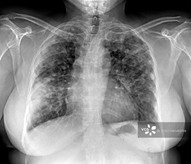 肺部疾病X光片图片素材