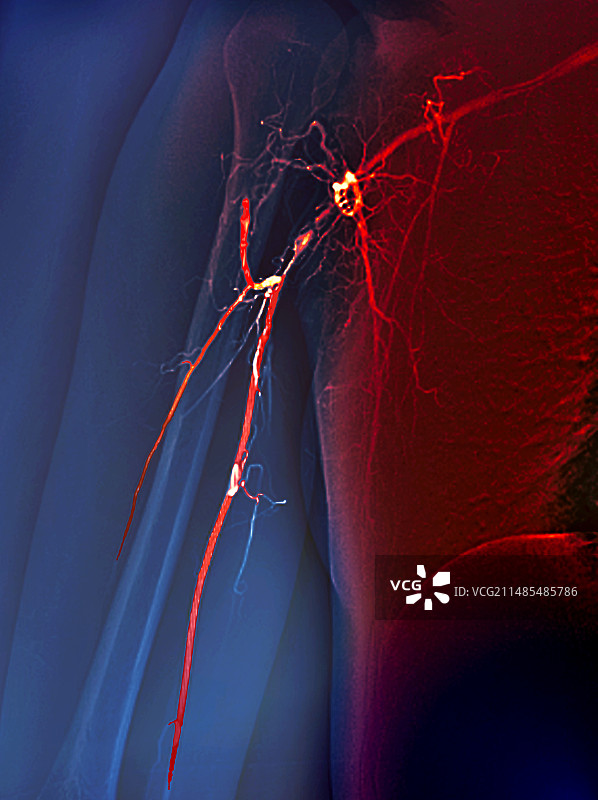 高安动脉炎血管造影图片素材