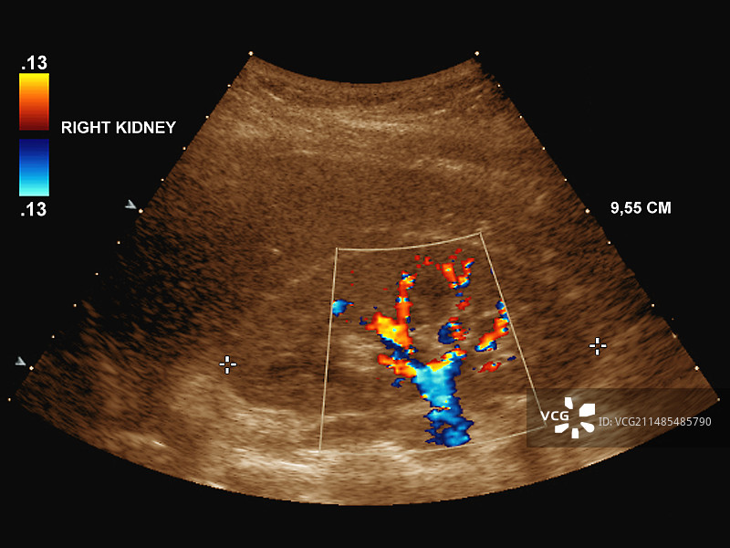 健康的肾脏，超声波扫描图片素材