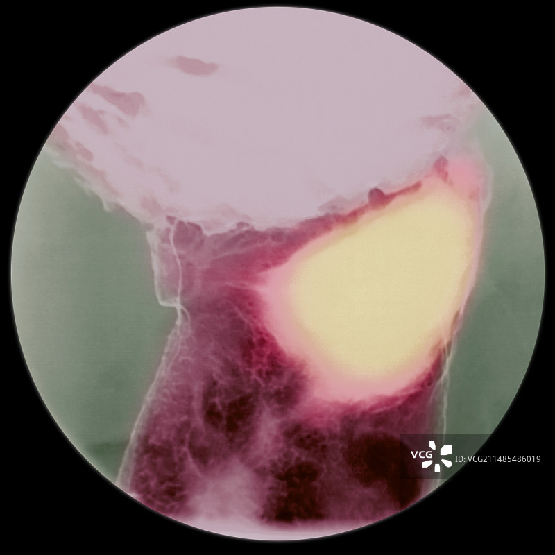 胃溃疡X光片图片素材