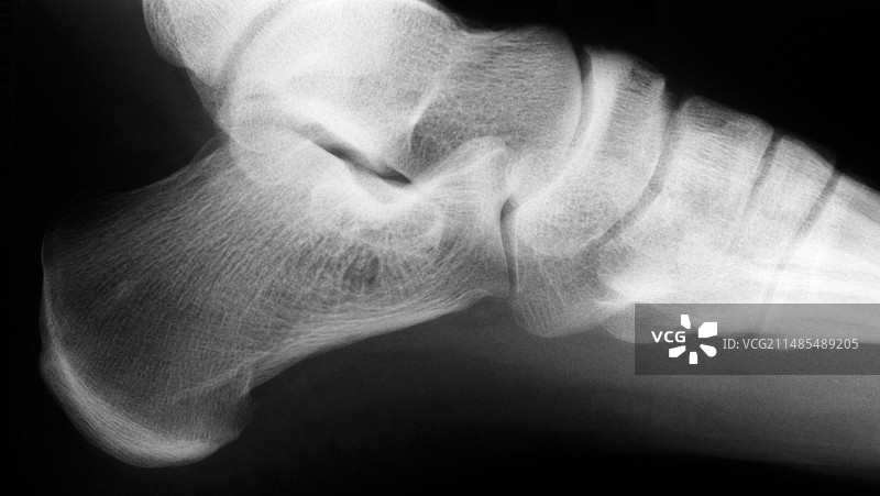 踝关节X光片图片素材