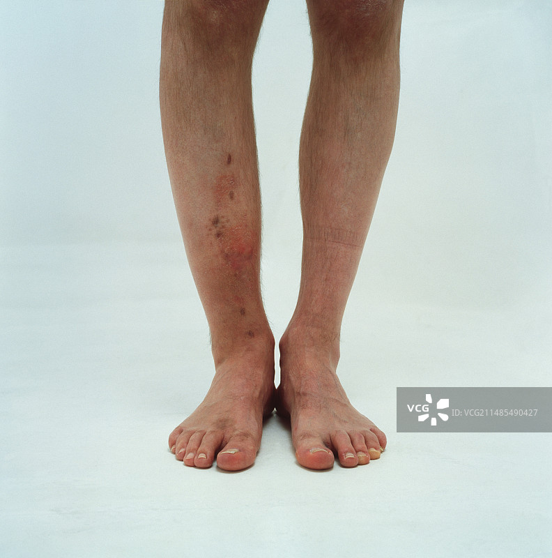 腿部骨折图片素材