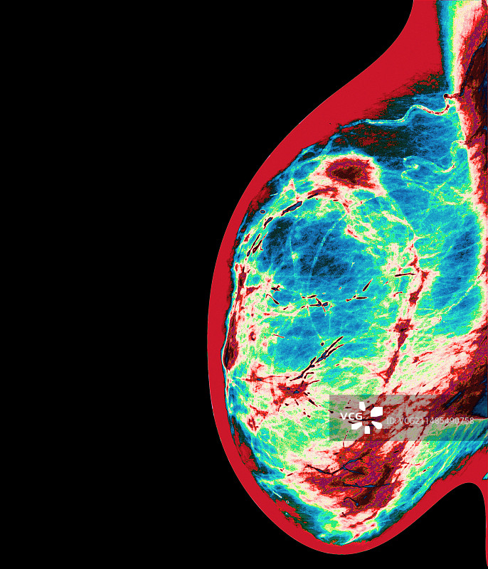 乳腺炎X光片图片素材