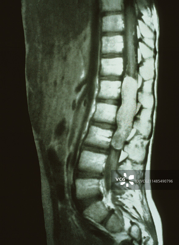 脊髓癌MRI图片素材