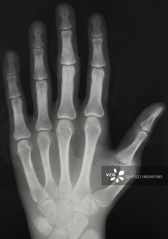 关节炎手部X光片图片素材