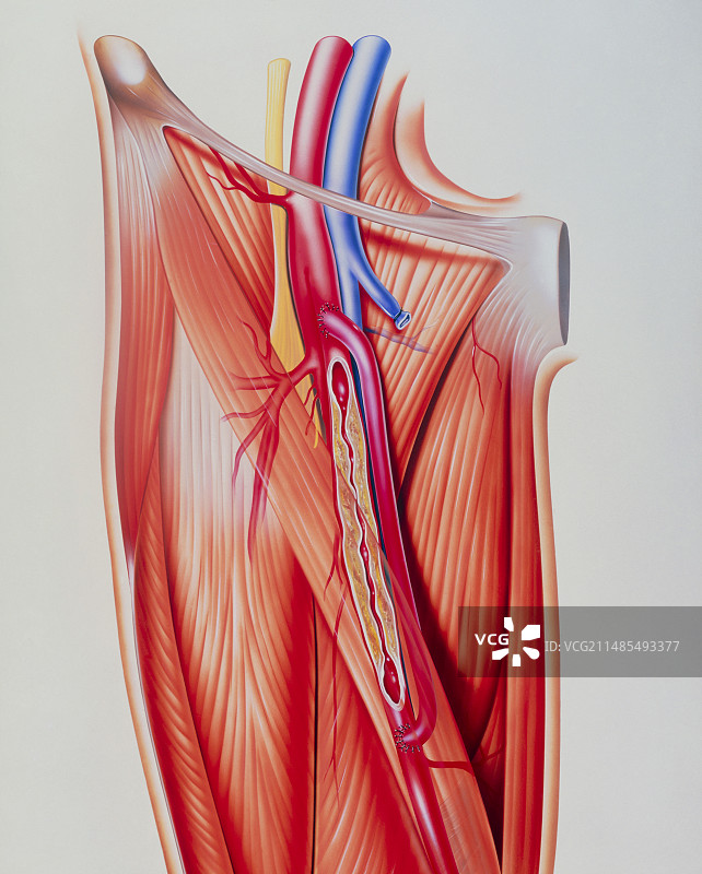 动脉搭桥术图片素材