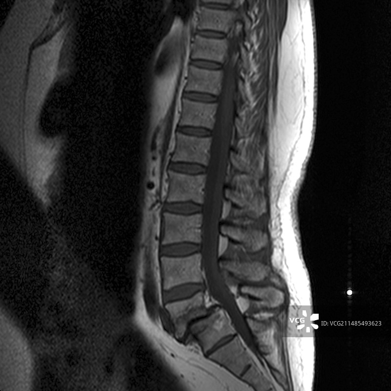 脊椎滑脱核磁共振扫描图片素材