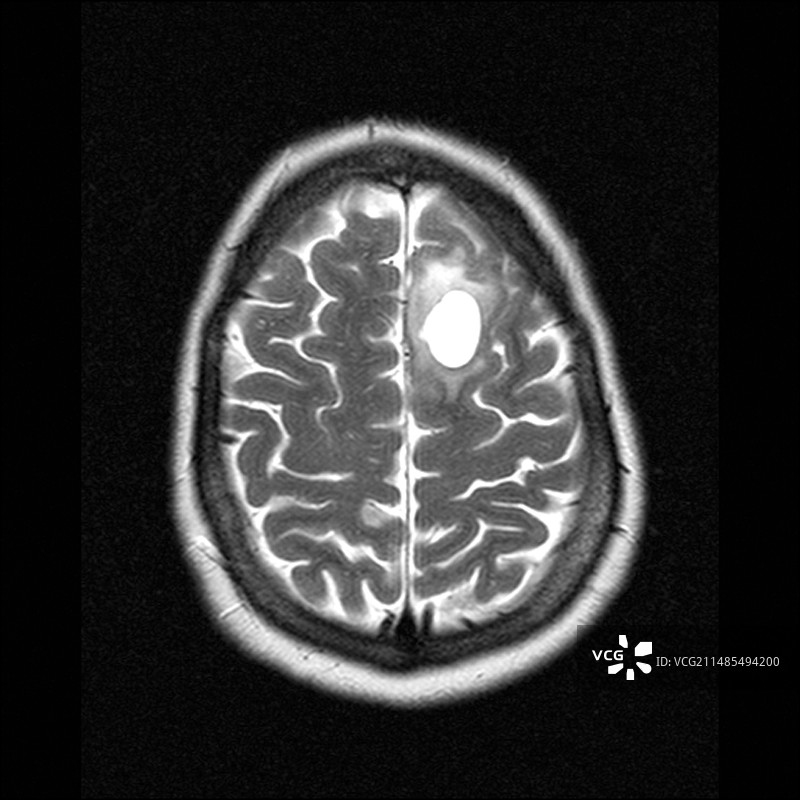 脑肿瘤核磁共振扫描图片素材