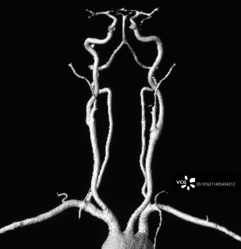 胸颈部和头部动脉MRA扫描图片素材