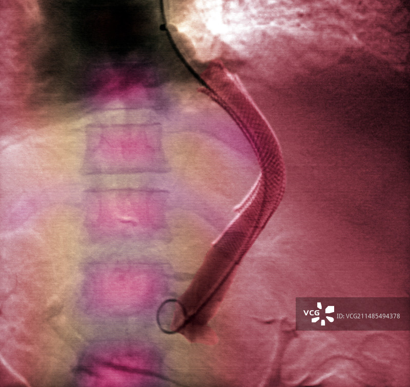 门静脉手术图片素材
