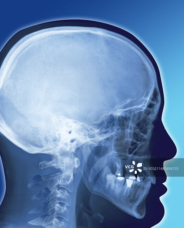 健康的头骨X光片图片素材